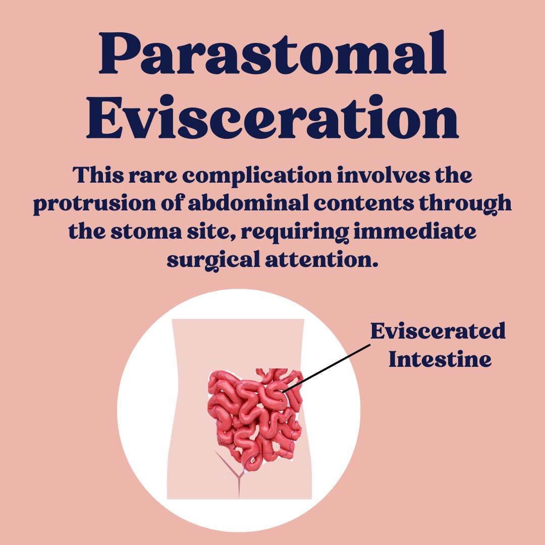 Here are a few uncommon complications that could result in stoma surgery, which you might not be familiar with! 

Stay informed about these unexpected issues. 🌟  

Understanding the rare causes can help prepare you for what to look out for.