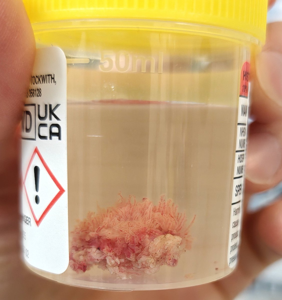 DrAngusLuk's tweet image. The beauty of en-bloc resection! 
#ERBT #BladderCancer #NMIBC #UroSoMe