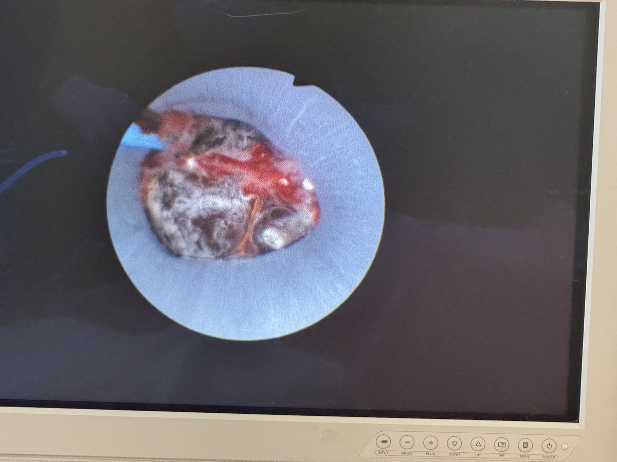 Will Finch (@mrwillfinch) on Twitter photo Very rewarding to see <a href="/UrolinkUrology/">Urolink</a> training in Hawassa ๐ช๐น produce independent surgeons, reduced LOS and recovery and stone free patients ๐ <a href="/shekharbiyani/">Shekhar Biyani</a> <a href="/PCB_Anderson/">Paul Anderson</a> <a href="/BJUIjournal/">BJU International</a> <a href="/BAUSurology/">BAUS</a> <a href="/BAUSendourology/">BAUS Endourology</a> Very rewarding to see <a href="/UrolinkUrology/">Urolink</a> training in Hawassa ๐ช๐น produce independent surgeons, reduced LOS and recovery and stone free patients ๐ <a href="/shekharbiyani/">Shekhar Biyani</a> <a href="/PCB_Anderson/">Paul Anderson</a> <a href="/BJUIjournal/">BJU International</a> <a href="/BAUSurology/">BAUS</a> <a href="/BAUSendourology/">BAUS Endourology</a>