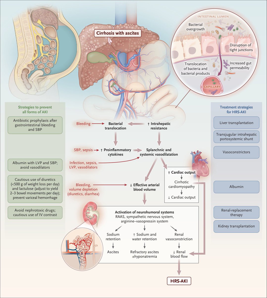 🎯#NEJM Review

Acute Kidney Injury in Patients with Cirrhosis

nejm.org/doi/full/10.10…