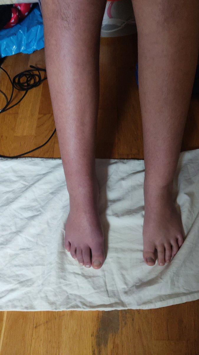 Estoy desesperada, por favor alguien me puede poner en contacto con  algún especialista en dolor regional complejo? (España)  Esta es mi peque , ya no come ni duerme, su movilidad es -1 , sufre dolor constante, llevamos así 5 meses (está en la unidad del dolor y rehabilitación)