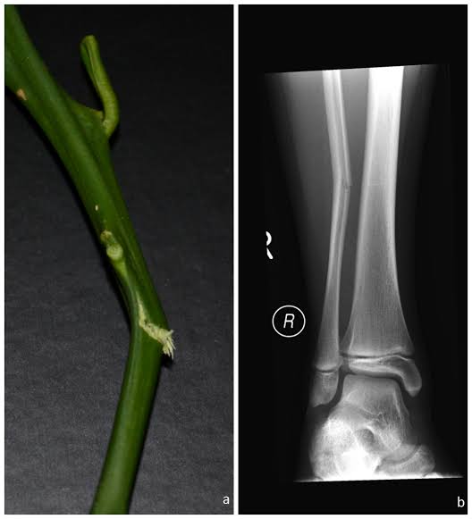 Unlike other fracture types, a greenstick fracture is incomplete and does not extend through the entire periosteum of the bone.

This is because the periosteum in children is thick and flexible, and provides resistance and prevents a complete break on the opposite side.