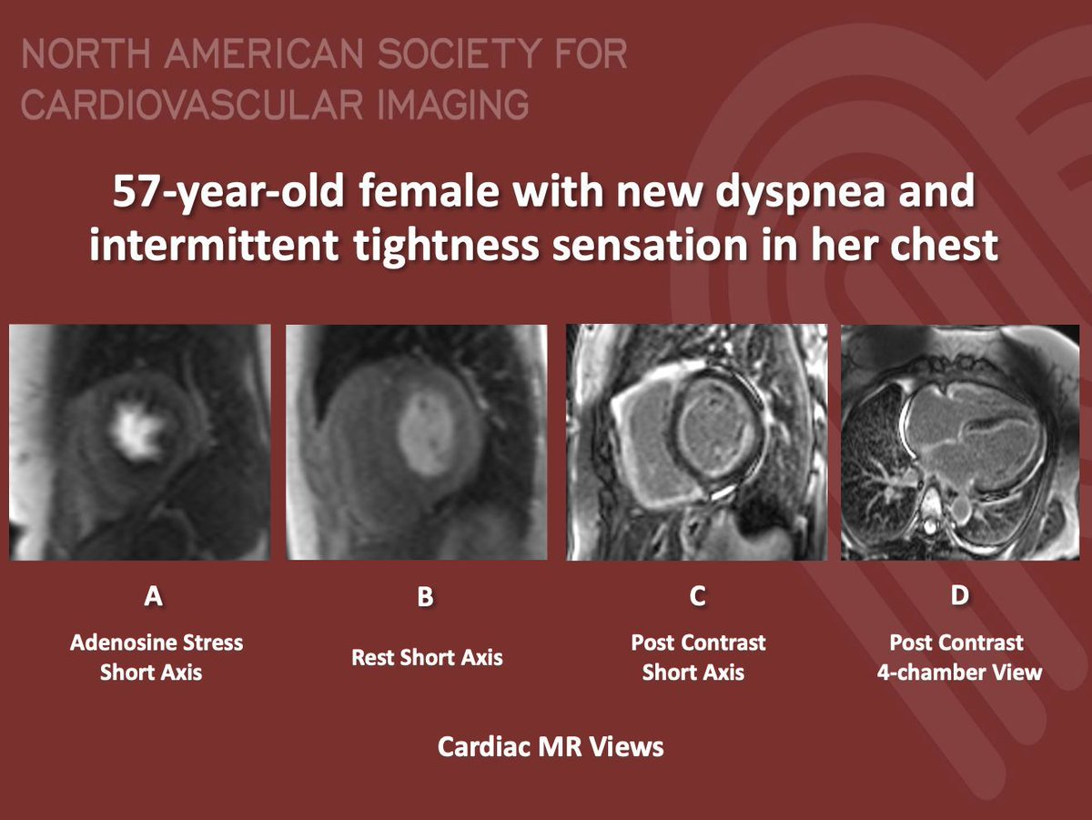 NASCI (@nascisociety) on Twitter photo #NASCI Case Series
Case 77
Courtesy of Busra Cangut <a href="/BusraCangutMD/">Busra Cangut, MD, MS</a> from Mount Sinai Hospital, New York
What is the right answer?
#whyCMRÂ #YesCCT
<a href="/GregKicska/">Gregory Kicska</a>Â <a href="/JRevRad1/">Jonathan Revels DO, FSAR</a>Â <a href="/dianalitmano/">diana litmanovich</a>Â <a href="/DanielVargasMD/">Daniel Vargas, MD</a>Â <a href="/kirschj/">Jacobo Kirsch, MD, MBA, FACR</a>Â <a href="/prachipagarwal/">Prachi Agarwal</a>Â <a href="/AwsHamid5/">Aws Hamid, MD, MS</a> <a href="/EscrOffice/">ESCR Vienna</a> <a href="/CarlottaOnnis/">Carlotta Onnis</a> <a href="/DeCeccoCN/">Carlo N. De Cecco, MD, PhD</a> #NASCI Case Series
Case 77
Courtesy of Busra Cangut <a href="/BusraCangutMD/">Busra Cangut, MD, MS</a> from Mount Sinai Hospital, New York
What is the right answer?
#whyCMRÂ #YesCCT
<a href="/GregKicska/">Gregory Kicska</a>Â <a href="/JRevRad1/">Jonathan Revels DO, FSAR</a>Â <a href="/dianalitmano/">diana litmanovich</a>Â <a href="/DanielVargasMD/">Daniel Vargas, MD</a>Â <a href="/kirschj/">Jacobo Kirsch, MD, MBA, FACR</a>Â <a href="/prachipagarwal/">Prachi Agarwal</a>Â <a href="/AwsHamid5/">Aws Hamid, MD, MS</a> <a href="/EscrOffice/">ESCR Vienna</a> <a href="/CarlottaOnnis/">Carlotta Onnis</a> <a href="/DeCeccoCN/">Carlo N. De Cecco, MD, PhD</a>