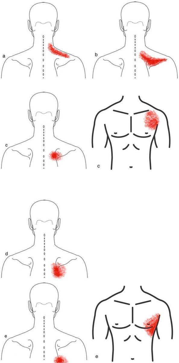 Typical pain patterns in radiculopathies- important for shoulder pain 

a) C5
b) C6
c) C7
d) C8 
e) T1

link.springer.com/article/10.100…