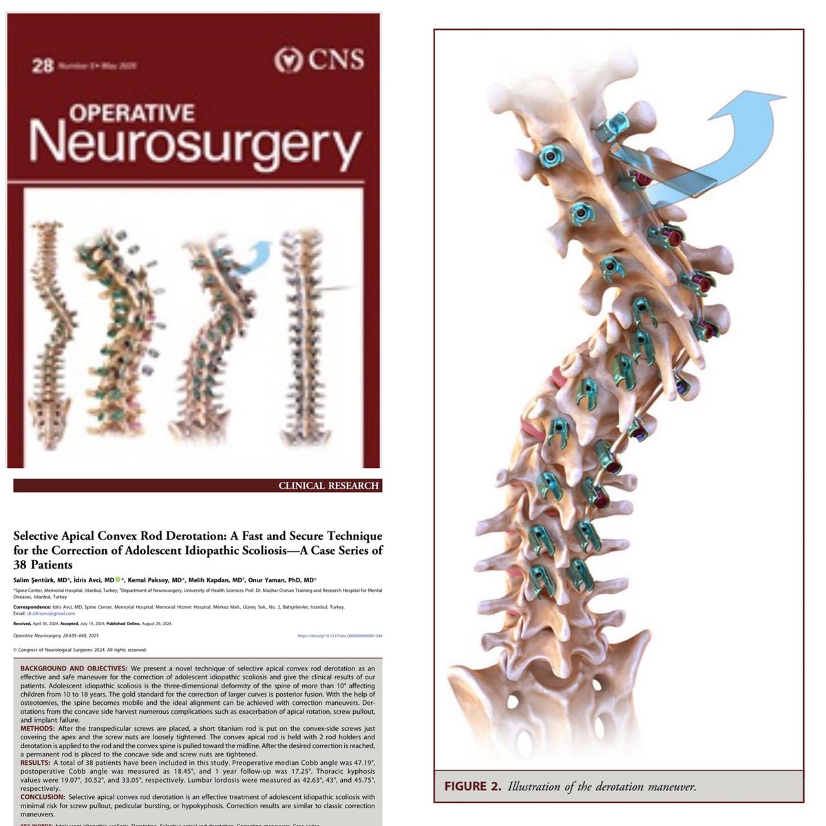 John H. Shin MD, MBA (@johnhshinmd) on Twitter photo Check out this what’s featured on the cover <a href="/NeurosurgeryCNS/">Neurosurgery Publications</a> this month: Selective Apical Convex Rod Derotation for Idiopathic Scoliosis: Operative Neurosurgery
<a href="/CNS_Update/">CNS</a> <a href="/DKondziolkaCNS/">Douglas Kondziolka</a>
journals.lww.com/onsonline/abst… Check out this what’s featured on the cover <a href="/NeurosurgeryCNS/">Neurosurgery Publications</a> this month: Selective Apical Convex Rod Derotation for Idiopathic Scoliosis: Operative Neurosurgery
<a href="/CNS_Update/">CNS</a> <a href="/DKondziolkaCNS/">Douglas Kondziolka</a>
journals.lww.com/onsonline/abst…