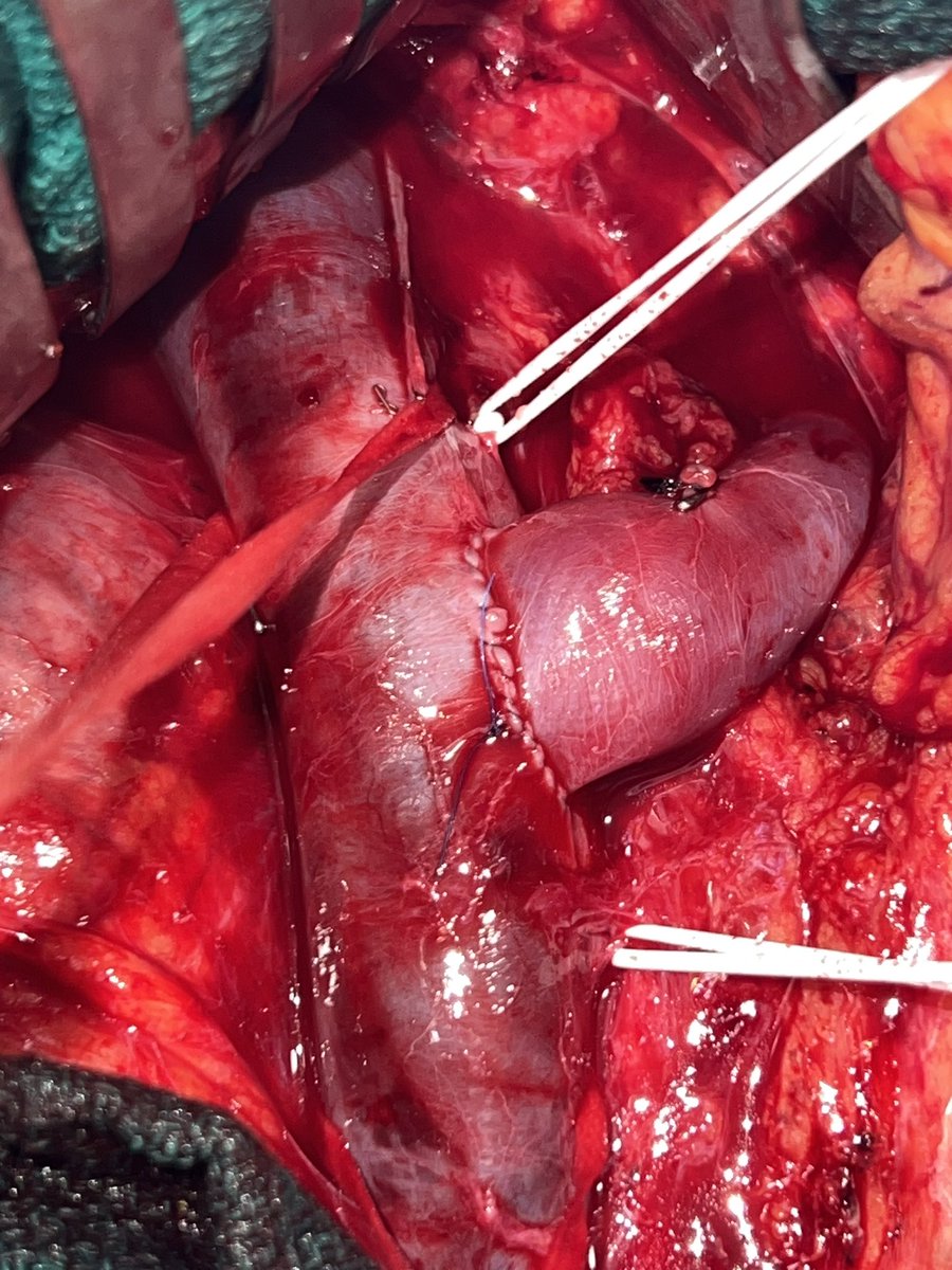 JHH Vascular Surgery (@jhhvascular) on Twitter photo Left renal vein transposition for an impressive case of #nutcrackersyndrome
<a href="/CaitlinWHicks/">Caitlin Hicks MD, MS</a> <a href="/AlexisLauria1/">Alexis Lauria</a> <a href="/hopkinssurgery/">Hopkins Surgery</a> Left renal vein transposition for an impressive case of #nutcrackersyndrome
<a href="/CaitlinWHicks/">Caitlin Hicks MD, MS</a> <a href="/AlexisLauria1/">Alexis Lauria</a> <a href="/hopkinssurgery/">Hopkins Surgery</a>