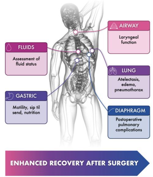 ❓ Is there a place for #POCUS in #ERAS? 

Authors <a href="/rosie_hogg/">Rosie Hogg</a> <a href="/elboghdadly/">Kariem</a> bring this framework that could support greater success in recovery protocols for #anesthesiologists
@iars_360 @iars_journals

buff.ly/GqeIv8l