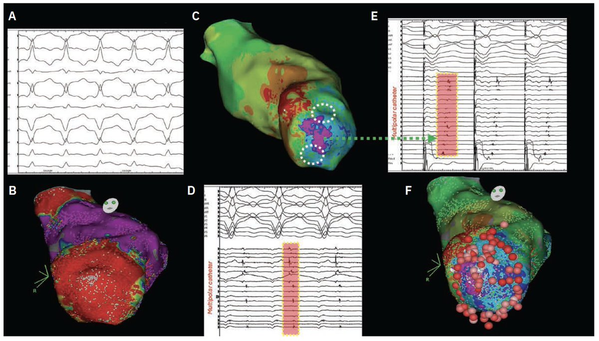 EP Lab Digest (@eplabdigest) on Twitter photo Drs. Carmel Ashur, Wendy Tzou, and <a href="/Dr_LohitG/">Lohit Garg</a> unpack best practices for #VT ablation—integrating cutting-edge mapping technologies, ablation strategies, and periprocedural management for optimal patient care. A must-read for EP professionals! hubs.ly/Q03lG2XT0 Drs. Carmel Ashur, Wendy Tzou, and <a href="/Dr_LohitG/">Lohit Garg</a> unpack best practices for #VT ablation—integrating cutting-edge mapping technologies, ablation strategies, and periprocedural management for optimal patient care. A must-read for EP professionals! hubs.ly/Q03lG2XT0