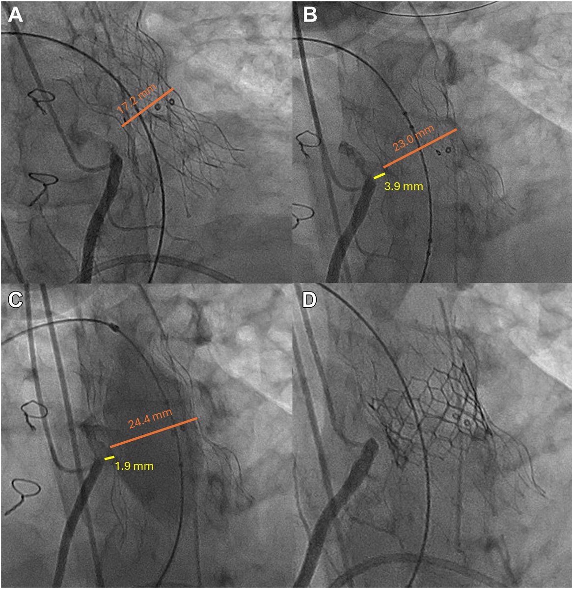 MyJSCAI (@myjscai) on Twitter photo 🆕Case Report: off-label #TPVR w Alterra & 26 mm Sapien S3💡Read the pt outcome:
➡️doi.org/10.1016/j.jsca…
<a href="/mlbocks/">Martin Bocks, MD</a> 🆕Case Report: off-label #TPVR w Alterra & 26 mm Sapien S3💡Read the pt outcome:
➡️doi.org/10.1016/j.jsca…
<a href="/mlbocks/">Martin Bocks, MD</a>