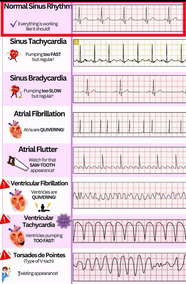 EKG rhythms