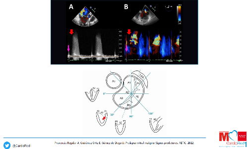 CardioTeca (@cardioteca) on Twitter photo 💛 Prolapso valvular mitral
Gonzalo García Martí <a href="/GGarciaMarti/">Gonzalo García Martí</a>
✏️ Regístrate en CardioTeca y descarga las diapositivas ⤵️
cardioteca.com/diapositivas-p… 💛 Prolapso valvular mitral
Gonzalo García Martí <a href="/GGarciaMarti/">Gonzalo García Martí</a>
✏️ Regístrate en CardioTeca y descarga las diapositivas ⤵️
cardioteca.com/diapositivas-p…
