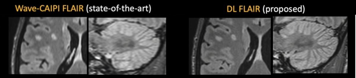 Susanna I Lee (@susannaleerad) on Twitter photo Brain MRI for multiple sclerosis. AI acceleration of 3D FLAIR results in 30% faster image acquisition with better image quality and lesion conspicuity!
<a href="/RSNA/">RSNA</a> <a href="/OUPMedicine/">OUP Medicine</a> <a href="/MGHMartinos/">MGH Martinos Center</a> <a href="/SusieHuangMDPhD/">Susie Huang</a> <a href="/mghradchiefs/">MGH Radiology Chiefs</a> #RadAdv
doi.org/10.1093/radadv… Brain MRI for multiple sclerosis. AI acceleration of 3D FLAIR results in 30% faster image acquisition with better image quality and lesion conspicuity!
<a href="/RSNA/">RSNA</a> <a href="/OUPMedicine/">OUP Medicine</a> <a href="/MGHMartinos/">MGH Martinos Center</a> <a href="/SusieHuangMDPhD/">Susie Huang</a> <a href="/mghradchiefs/">MGH Radiology Chiefs</a> #RadAdv
doi.org/10.1093/radadv…