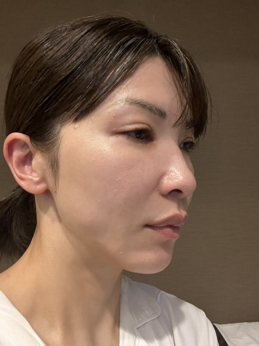 左側はラインも綺麗だしほおコケも🍇でヒアルやってもらったからまあまあ綺麗かなと思ってるんだけど、右側はなんか脂肪がボールみたいな形で浮き出てるしラインがぼやけてて何だかなぁ
ボルウェーブ後から1ヶ月経ちました！
確かに小皺に効いてる気がする！