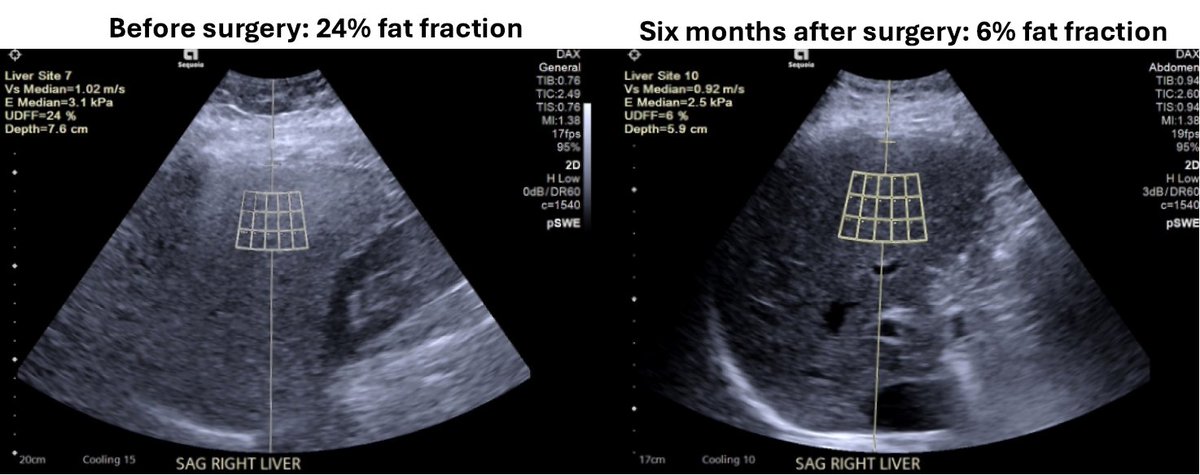 Susanna I Lee (@susannaleerad) on Twitter photo A prospective study of changes in liver fat following bariatric surgery for obesity. Quantification of fat fraction with ultrasound correlates with the reduction in BMI (r = 0.75, p < 0.001).
<a href="/RSNA/">RSNA</a> <a href="/OUPMedicine/">OUP Medicine</a> <a href="/nandadeepamd/">Nanda Thimmappa MD</a> #RadAdv
doi.org/10.1093/radadv… A prospective study of changes in liver fat following bariatric surgery for obesity. Quantification of fat fraction with ultrasound correlates with the reduction in BMI (r = 0.75, p < 0.001).
<a href="/RSNA/">RSNA</a> <a href="/OUPMedicine/">OUP Medicine</a> <a href="/nandadeepamd/">Nanda Thimmappa MD</a> #RadAdv
doi.org/10.1093/radadv…