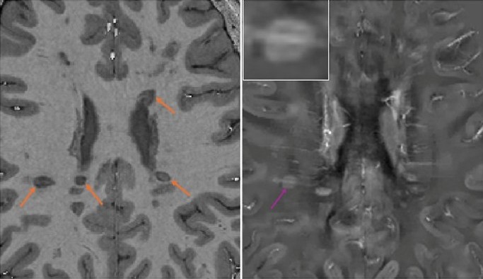Journal of Neuroimaging (@jneuroimaging) on Twitter photo T1‐Dark Rim as a Marker of New and Chronic Active Multiple Sclerosis Lesions: A Serial Study With Frequent 7T MRI
onlinelibrary.wiley.com/doi/full/10.11…
#neuroimaging #neurology #neurorad #radres <a href="/WileyNeuro/">Wiley Neuro</a> <a href="/asneuroimaging/">American Society of Neuroimaging</a> #multiplesclerosis #chronicactivelesions #7T #MRI
Free read T1‐Dark Rim as a Marker of New and Chronic Active Multiple Sclerosis Lesions: A Serial Study With Frequent 7T MRI
onlinelibrary.wiley.com/doi/full/10.11…
#neuroimaging #neurology #neurorad #radres <a href="/WileyNeuro/">Wiley Neuro</a> <a href="/asneuroimaging/">American Society of Neuroimaging</a> #multiplesclerosis #chronicactivelesions #7T #MRI
Free read