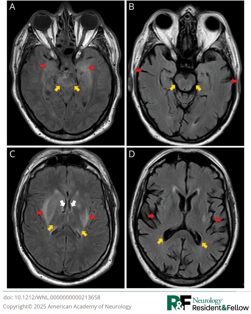 A 72-year-old man presented to the emergency department with fever, meningismus, and focal neurologic deficits, after 5 days of fatigue, malaise, headache, and encephalopathy. Read more:  hubs.la/Q03mnvgw0 
#NeuroTwitter #Meningoencephalitis