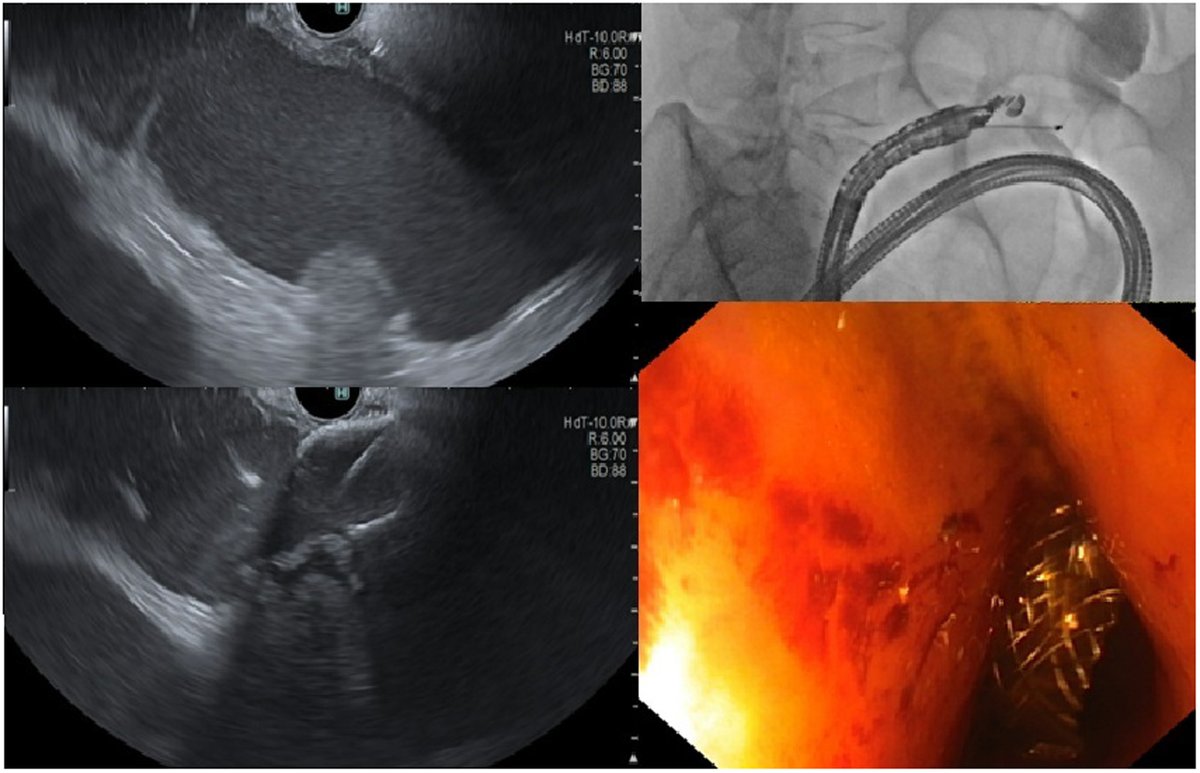 TIGE (@aga_tige) on Twitter photo β FEATURED ARTICLE β
π° Role of Endoscopic Ultrasound-Guided Gastrointestinal Anastomosis for Gastric Outlet Obstruction, Endoscopic Access, and Enteric Decompression
π¨ββοΈ <a href="/MBronswijkMD/">Michiel Bronswijk | MD</a>
π ow.ly/5znR50VRbuS β FEATURED ARTICLE β
π° Role of Endoscopic Ultrasound-Guided Gastrointestinal Anastomosis for Gastric Outlet Obstruction, Endoscopic Access, and Enteric Decompression
π¨ββοΈ <a href="/MBronswijkMD/">Michiel Bronswijk | MD</a>
π ow.ly/5znR50VRbuS