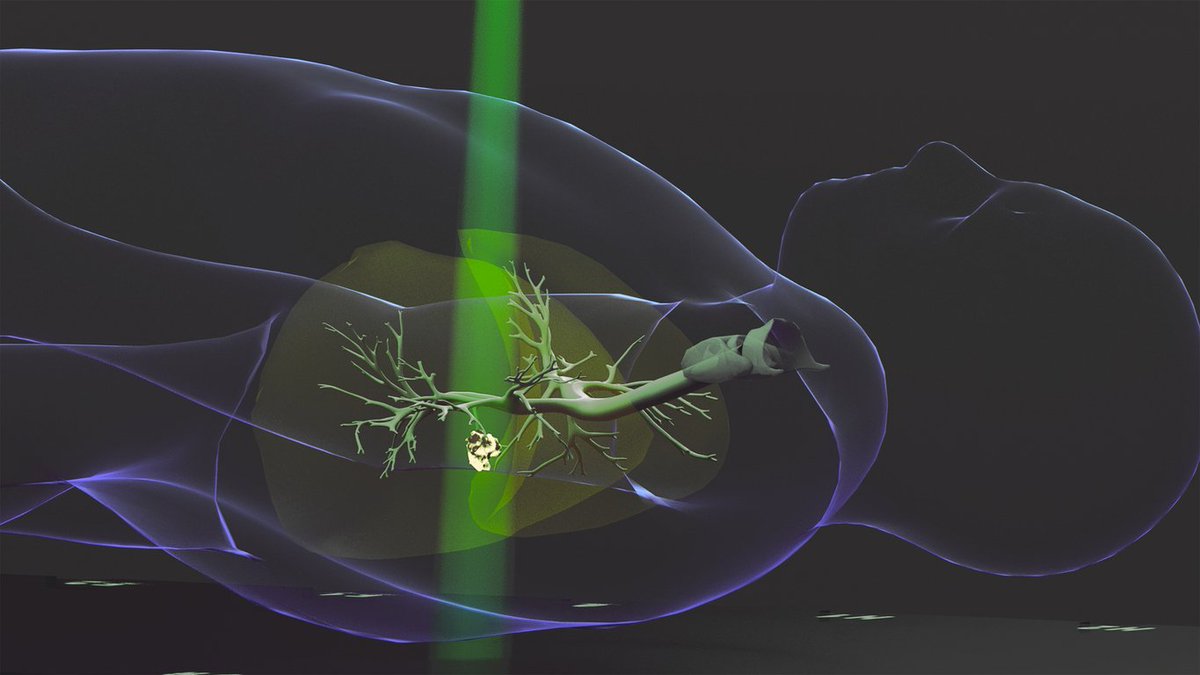 UChicagoCancerCenter (@uccancercenter) on Twitter photo 🔥 Hot off the press: Ralph Weichselbaum, MD, and his team published a new study in <a href="/Nature/">nature</a> demonstrating that high-dose radiation to primary tumors can unexpectedly promote tumor growth at metastatic sites.
<a href="/rweichselbaum/">Ralph Weichselbaum</a> <a href="/AndrasPiffko/">Andras Piffko</a> <a href="/UChicagoRadonc/">University of Chicago Radiation Oncology</a>
uchicagomedicine.org/forefront/canc… 🔥 Hot off the press: Ralph Weichselbaum, MD, and his team published a new study in <a href="/Nature/">nature</a> demonstrating that high-dose radiation to primary tumors can unexpectedly promote tumor growth at metastatic sites.
<a href="/rweichselbaum/">Ralph Weichselbaum</a> <a href="/AndrasPiffko/">Andras Piffko</a> <a href="/UChicagoRadonc/">University of Chicago Radiation Oncology</a>
uchicagomedicine.org/forefront/canc…