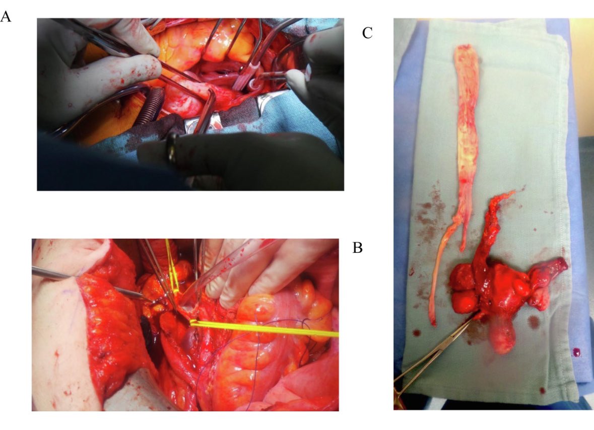 Management of intravenous leiomyomatosis <a href="/SGO_org/">SGO</a> <a href="/IGCSociety/">IGCS</a> <a href="/ESGO_society/">ESGO</a> <a href="/ASCO/">ASCO</a> <a href="/OncoAlert/">OncoAlert</a> sciencedirect.com/science/articl…