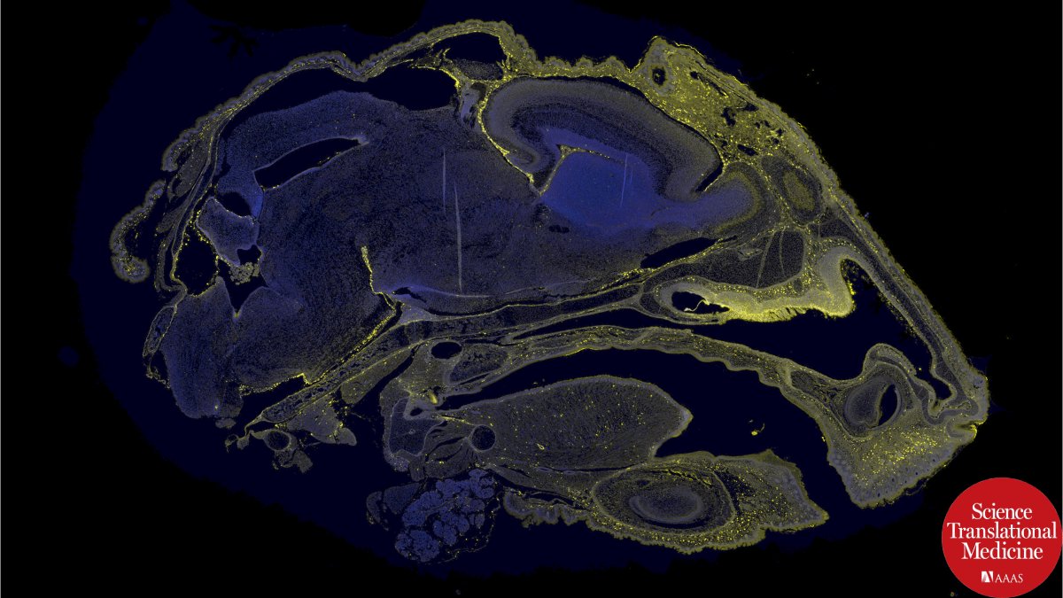UCSF Center for Maternal-Fetal Precision Medicine (@ucsfcmfpm) on Twitter photo Intra-amniotic ASO treatment improves phenotypes in preclinical SMA models, suggesting a promising, minimally invasive prenatal approach for SMA and other early-onset neurological disorders. @MacKenzieTippi lab, <a href="/UCSF/">UC San Francisco</a>, @UCDavis, <a href="/HopkinsMedicine/">Johns Hopkins Medicine</a> bit.ly/4jV38tL Intra-amniotic ASO treatment improves phenotypes in preclinical SMA models, suggesting a promising, minimally invasive prenatal approach for SMA and other early-onset neurological disorders. @MacKenzieTippi lab, <a href="/UCSF/">UC San Francisco</a>, @UCDavis, <a href="/HopkinsMedicine/">Johns Hopkins Medicine</a> bit.ly/4jV38tL