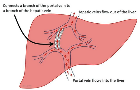 Salvador Benlloch (@doctorbenlloch) on Twitter photo EASL Clinical Practice Guidelines on TIPS - Journal of Hepatology journal-of-hepatology.eu/article/S0168-…
#cirrhosis #portalhypertension
<a href="/AEEHLiver/">Asociación Española para el Estudio del Hígado</a> EASL Clinical Practice Guidelines on TIPS - Journal of Hepatology journal-of-hepatology.eu/article/S0168-…
#cirrhosis #portalhypertension
<a href="/AEEHLiver/">Asociación Española para el Estudio del Hígado</a>