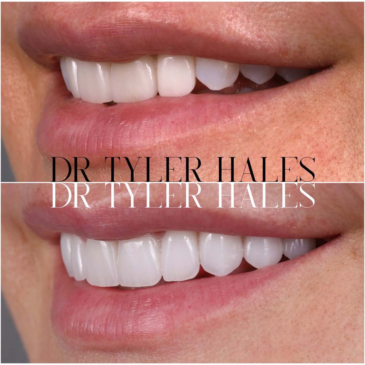 This patient had four old veneers that were dull and discolored. She wanted to transform the look of her smile so she opted for a full makeover with 10 porcelain Harmony veneers. Look at the details and character designed in her new veneers vs the dull and bulky older veneers.