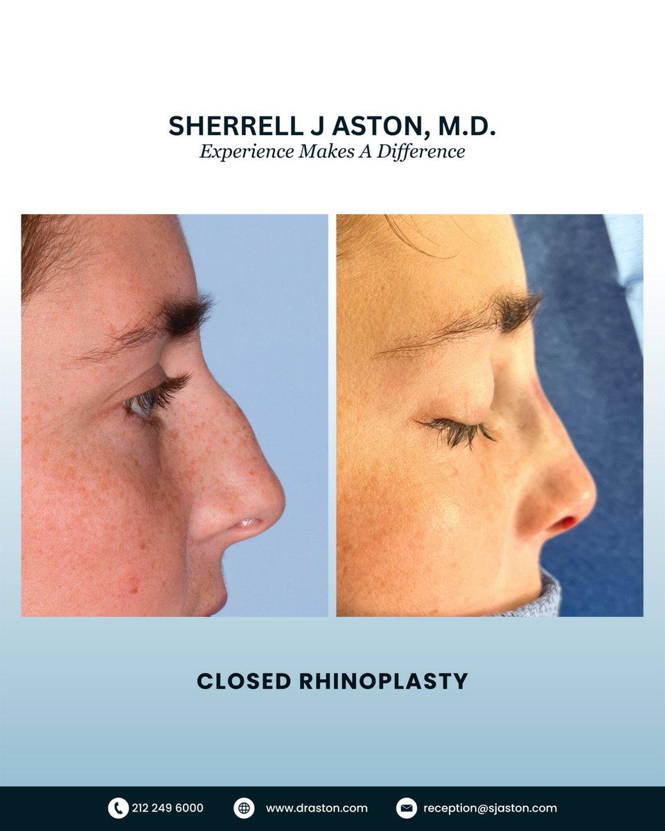 We started our day with this wonderful, pretty, 22-year-old recent college graduate. No external incisions, expected swelling and a beautiful start to healing!

#experiencemakesadifference #lovewhatido #nosebyaston #doctoraston #topplasticsurgeonsinamerica
