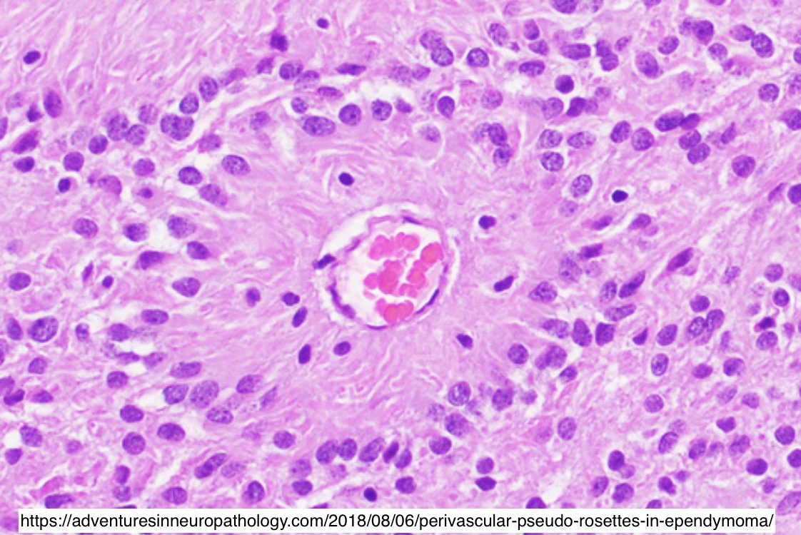 Which is a TRUE Rosette?   🤔 🏵️ 

#pathx #neuropath #medicalstudent #pathology #pathtwitter #neuro #hemeonc