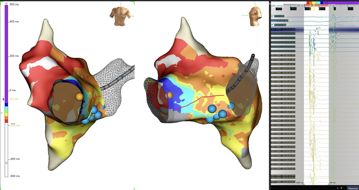 SoFloAbbottEP's tweet photo. HD Grid identifies conduction exiting the slow pathway, facilitating a successful ablation target for AVNRT.
#AbbottProud #HDGrid https://t.co/ekhTSafiKB