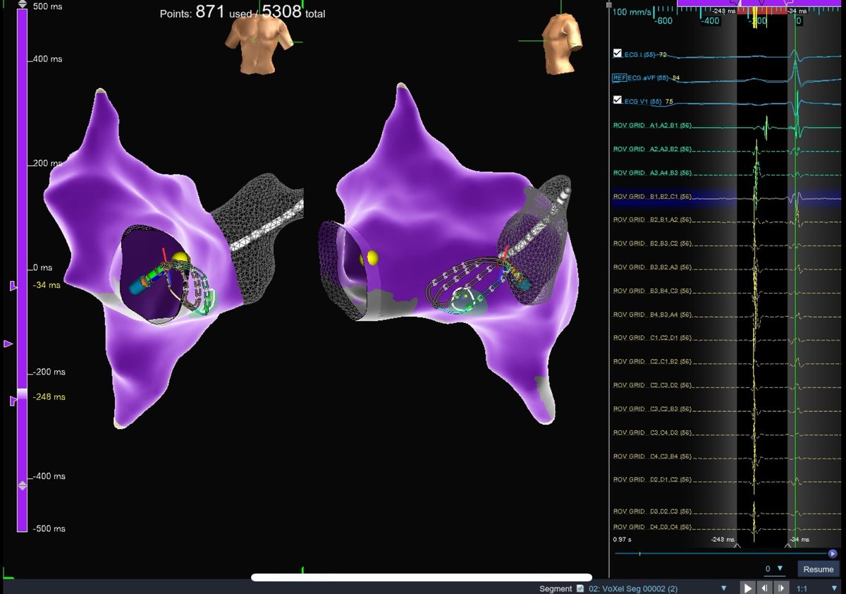 SoFloAbbottEP's tweet photo. HD Grid identifies conduction exiting the slow pathway, facilitating a successful ablation target for AVNRT.
#AbbottProud #HDGrid https://t.co/ekhTSafiKB