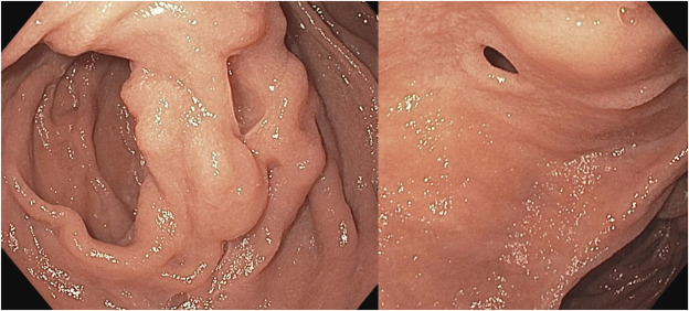 VideoGIE Journal (@videogie) on Twitter photo In this VideoGIE article, Grace E. Kim et al use a "A rendezvous approach for ampullary access in a strictured duodenojejunostomy." videogie.org/article/S2468-…
#GITwitter
<a href="/EricMontminyMD/">Eric Montminy, MD</a> In this VideoGIE article, Grace E. Kim et al use a "A rendezvous approach for ampullary access in a strictured duodenojejunostomy." videogie.org/article/S2468-…
#GITwitter
<a href="/EricMontminyMD/">Eric Montminy, MD</a>