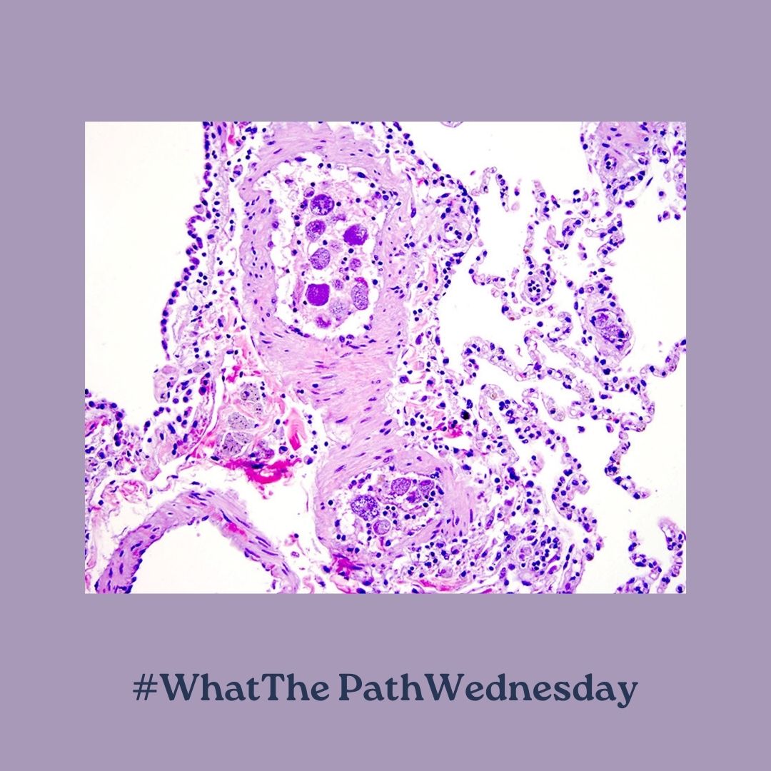 Today's #WhatThePathWednesday challenge is from an autopsy on a lion:

❓ Key microscopic features
❓ Cause
❓ Clin path findings

Check out the case in #VetPath via the links below:

👉Q: bit.ly/3V8xJue
👉A: bit.ly/49Jk29B