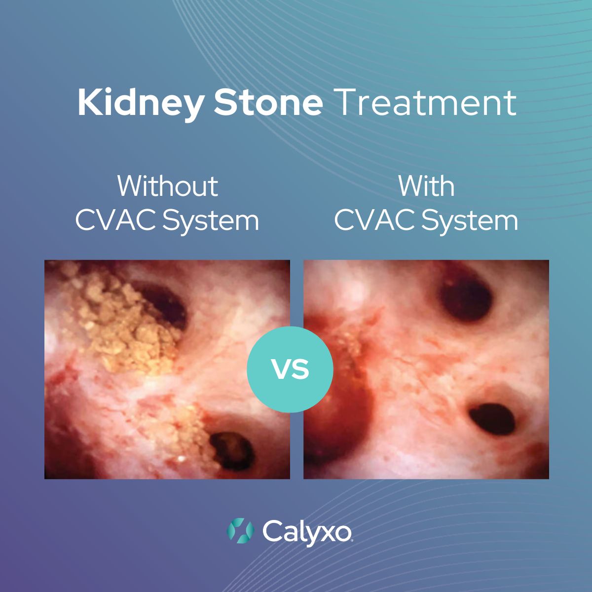 ❌ Without CVAC System:​
Residual kidney stone fragments remain after laser lithotripsy.​

✅ With CVAC System:​
Irrigation and aspiration are used to vacuum residual fragments during and after laser lithotripsy, enabling complete stone clearance!​

Watch case videos: