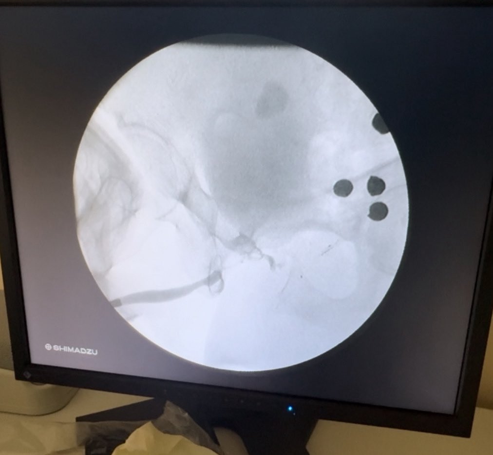Just another case of a bulbar stricture packed with some extra rounds.. #GSWsurvivor #Urethralstricture