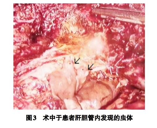 CJSC_Journal's tweet photo. 'Acute fascioliasis hepatica: a case report' an article on #ScienceOpen: https://t.co/GRgXCj1k5b https://t.co/3lKddV1Oji