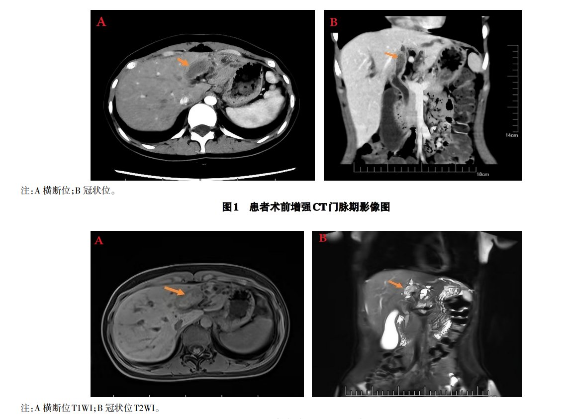 CJSC_Journal's tweet photo. 'Acute fascioliasis hepatica: a case report' an article on #ScienceOpen: https://t.co/GRgXCj1k5b https://t.co/3lKddV1Oji