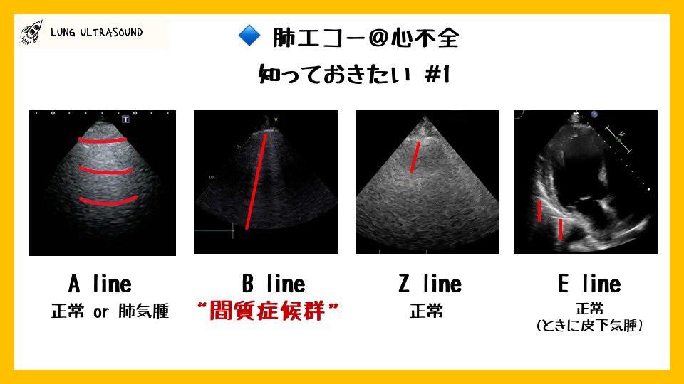 Shine様専用 心不全管理のための心×肺エコー 心不全の肺エコー