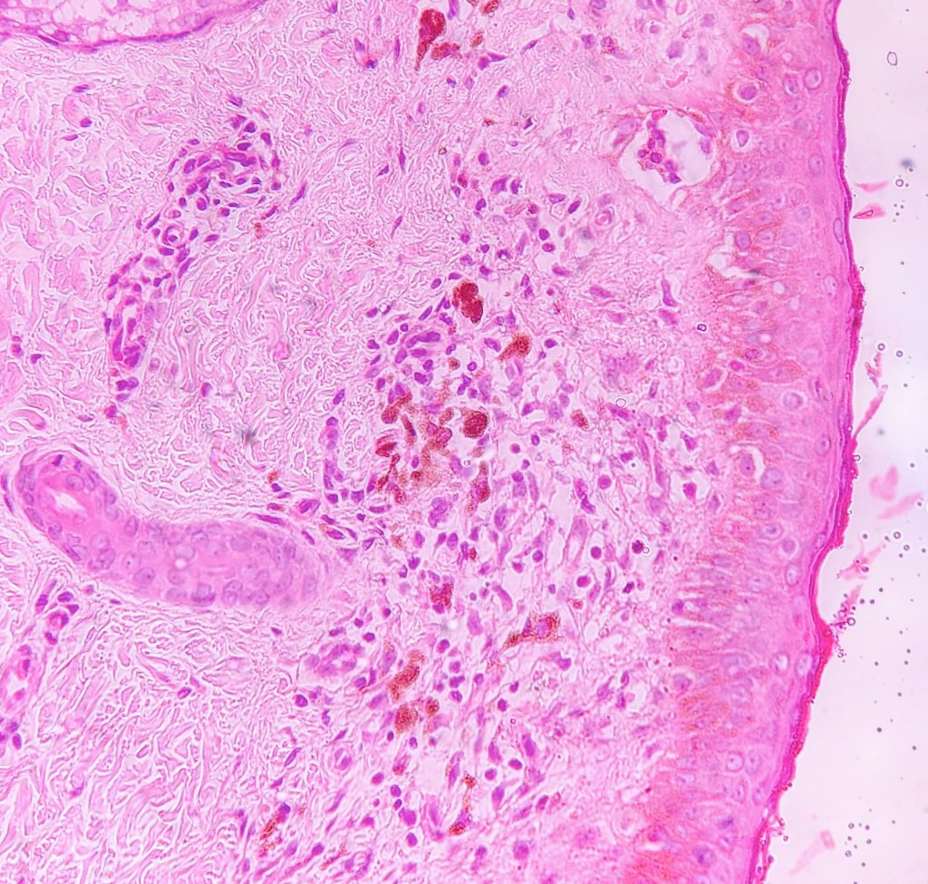 shalinirkr21's tweet photo. Upon the canvas of a youthful frame,
I leave a smoky, ashy stain,
Basal cells weakened, pigment cold.
A lichenoid band you may detect,
With melanophages in its effect.
Inflammation mild, a scattered crew,
Guess who I am; can you see through❓
13/F Skin Bx
@KMCMLR_Path
#dermpath https://t.co/kXy5MUEyxU