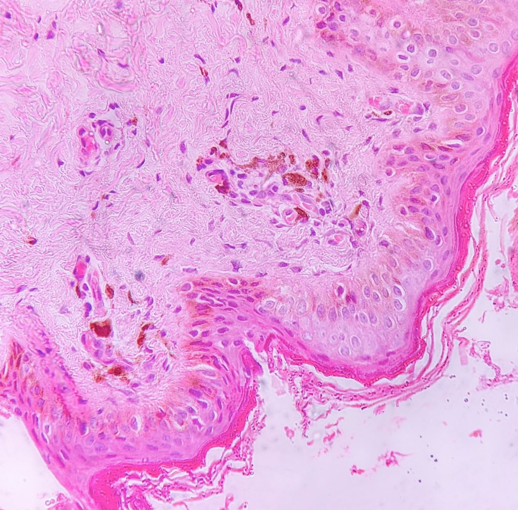 Upon the canvas of a youthful frame,
I leave a smoky, ashy stain,
Basal cells weakened, pigment cold.
A lichenoid band you may detect,
With melanophages in its effect.
Inflammation mild, a scattered crew,
Guess who I am; can you see through❓
13/F Skin Bx
<a href="/KMCMLR_Path/">Pathology KMC</a>
#dermpath