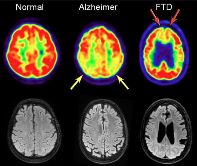 MetabolicFactor's tweet image. This is Dr. Dale Bredesen.
A brain doc who's probed Alzheimer’s & memory loss for 30+ years.
His take? Alzheimer’s isn’t game over—you can stall it, maybe rewind it.
That nukes the old script on brain fog and decline:🧵