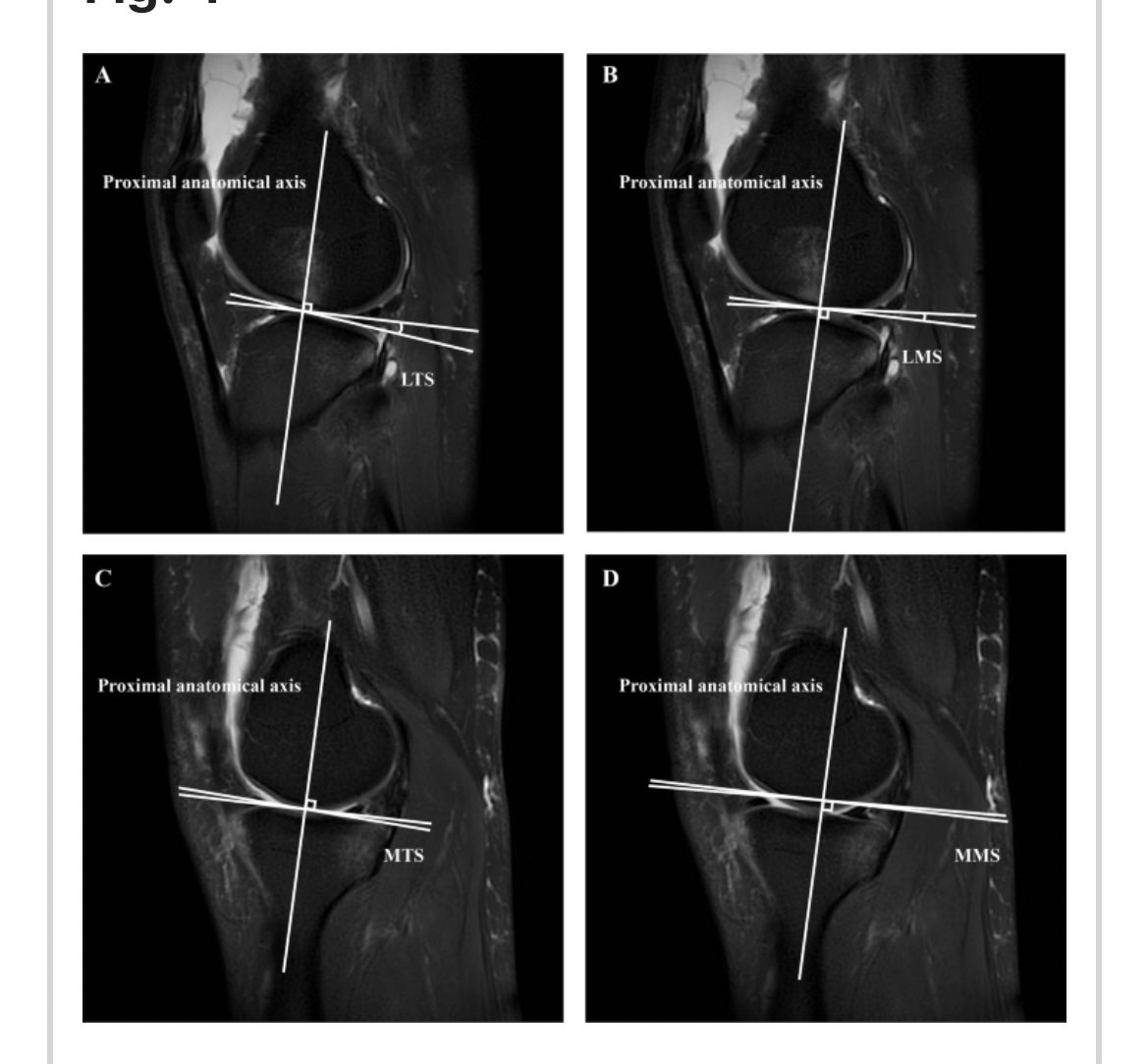 Steeper medial tibial and meniscal slopes are key predictors of ramp lesions in ACL-injured knees - each 1-deg increase in MTS and MMS was associated with a 2.18-fold and 1.73-fold increase in the odds of RL

nature.com/articles/s4159…