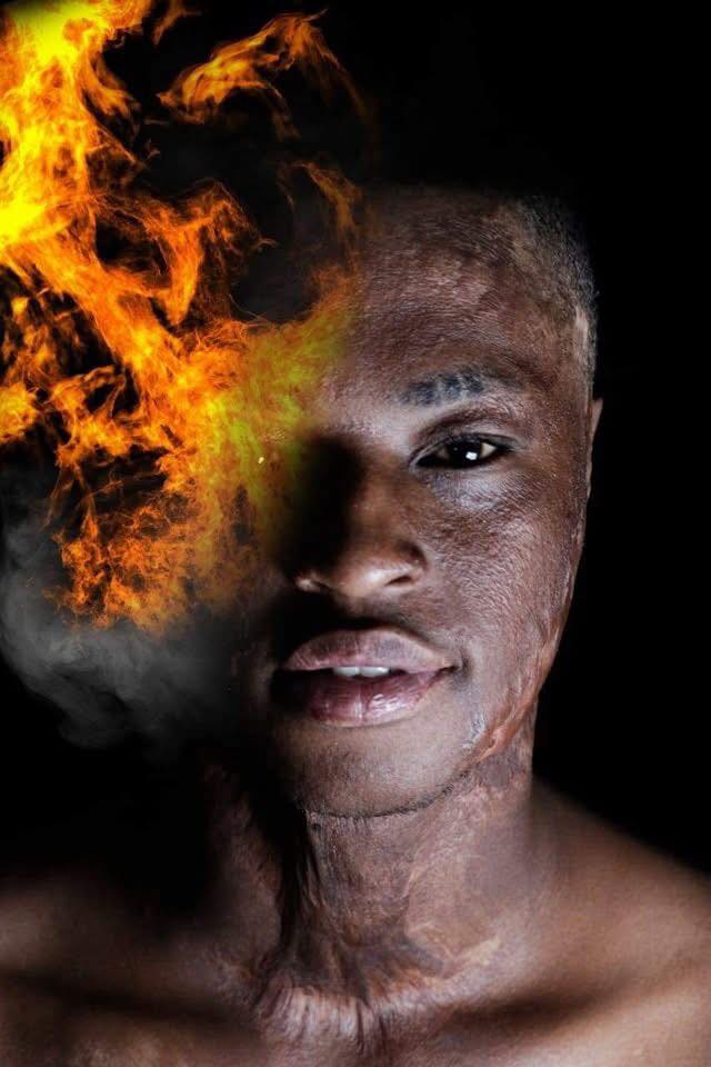 Meet the young South African 🇿🇦 Eastern Cape rugby player Qaphela Gobodo who was burned by his jealous 4 white classmates with paraffin after getting a scholarship