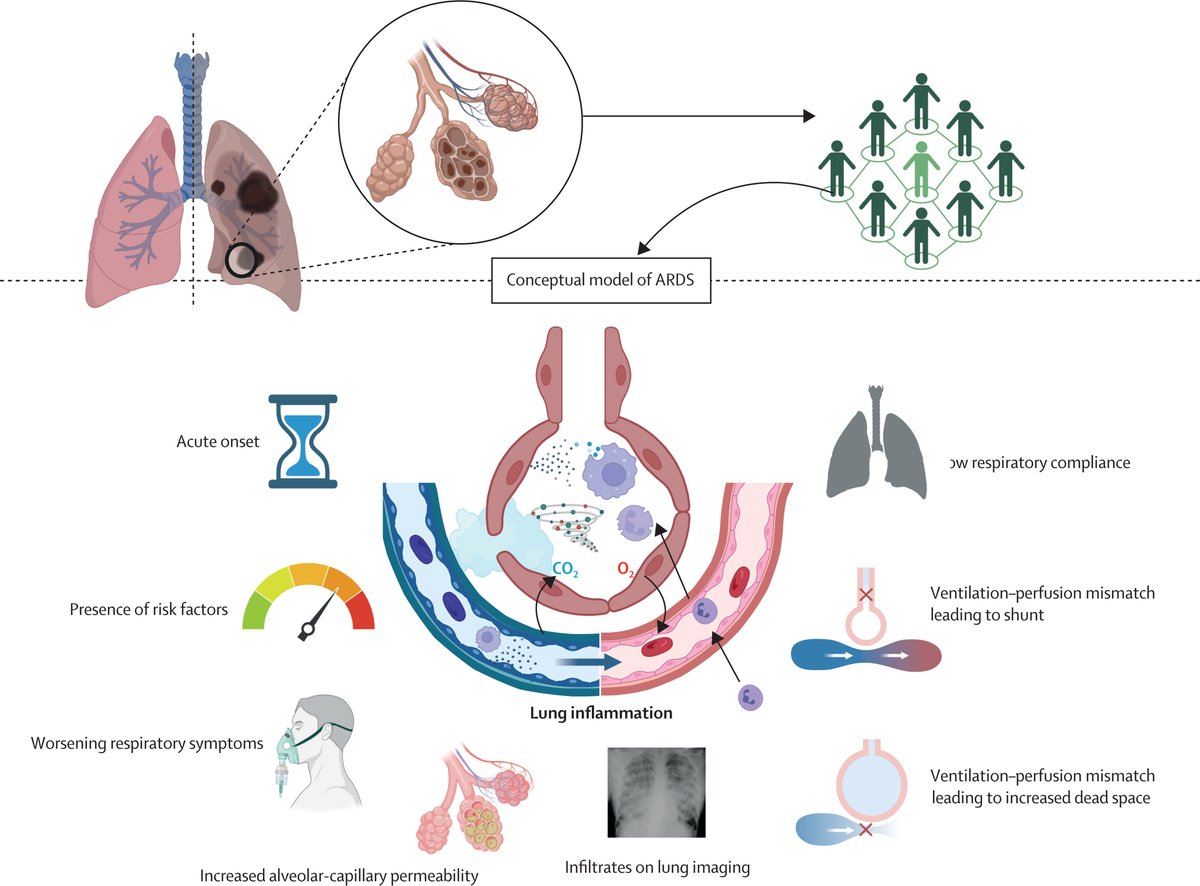 The Lancet (@thelancet) on Twitter photo Acute respiratory distress syndrome (ARDS) is a condition that affects people with severe breathing problems.
A new paper in <a href="/LancetRespirMed/">The Lancet Respiratory Medicine</a> looks to refine the definition of ARDS, explores avenues to improve current understanding and improve treatment options: Acute respiratory distress syndrome (ARDS) is a condition that affects people with severe breathing problems.
A new paper in <a href="/LancetRespirMed/">The Lancet Respiratory Medicine</a> looks to refine the definition of ARDS, explores avenues to improve current understanding and improve treatment options: