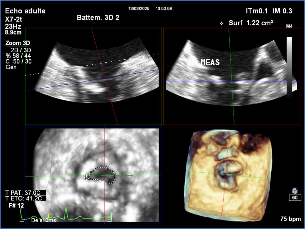 najibadn's tweet image. Rheumatic mitral stenosis in its extreme form with severe calcifications of the body leaflets and the posteromedial commissure
#echofirst @StellEkaterina
@Ed_Alania
@iamritu @CASivaram1 @argulian
@alexsfelixecho @DrRajeshG1 @ABCDEcografia @ASE360