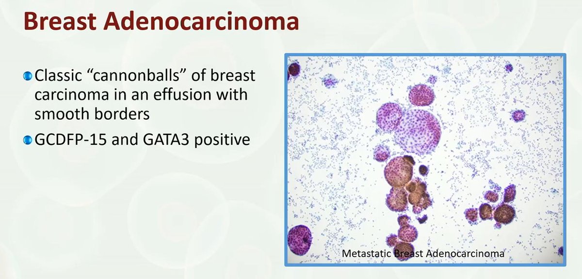 Cytology
Breast Adenocarcinoma

Dr. Siddiqui #USCAP25 #pathology #PathX #Pathboards