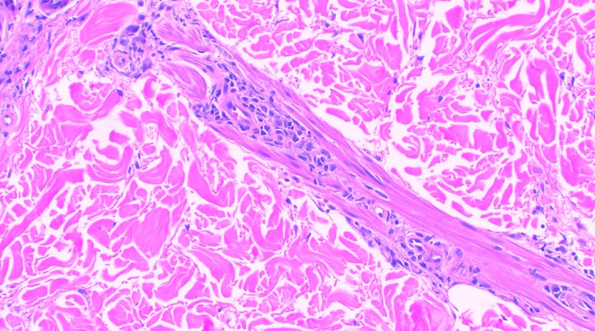 JCandidoXavier's tweet photo. inflammatory infiltrate inside the piloerector muscle is a clue for LEPROSY

#derm #dermatology #medicine #dermpath #pathology https://t.co/xz9D5es5dC