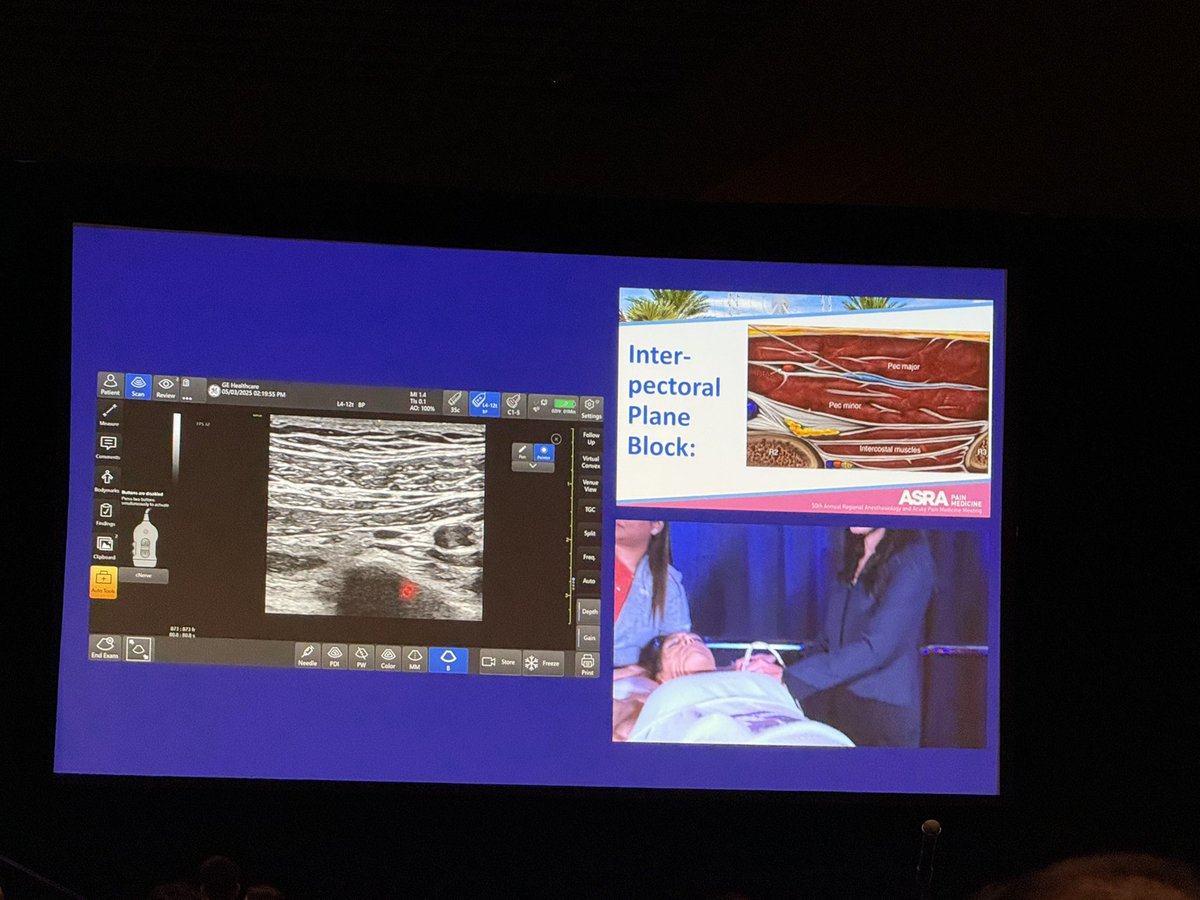 Steve Coppens (@steve_coppens) on Twitter photo Go go gooooo <a href="/Duke_Anesthesia/">Duke Anesthesiology</a> !!! Block demo by <a href="/AmandaKumarMD/">Amanda Kumar</a> #ASRA50 #ASRASPRING25 !!! Duke Fellowship and friends 🫶🏻🫶🏻🫶🏻🫶🏻🫶🏻🫶🏻forever ! Go go gooooo <a href="/Duke_Anesthesia/">Duke Anesthesiology</a> !!! Block demo by <a href="/AmandaKumarMD/">Amanda Kumar</a> #ASRA50 #ASRASPRING25 !!! Duke Fellowship and friends 🫶🏻🫶🏻🫶🏻🫶🏻🫶🏻🫶🏻forever !