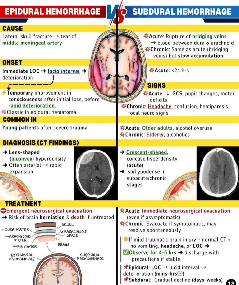 Epidural vs Subdural brain bleed