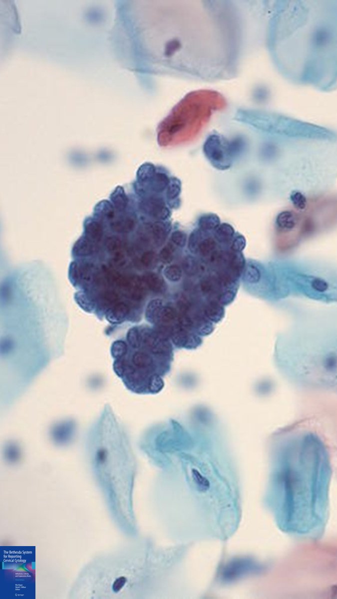 Screening pap smear.
What would you call these cells?
🤔 
A) High grade squamous lesion (HSIL)
B) Atypical glandular cells (AGC)
C) Benign endometrial cells 
D) Tubal metaplasia
#CytoPath #Pathology