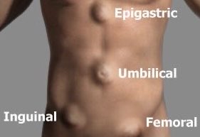 Awful
To 
Have 
All 
Of 
These
Hernias